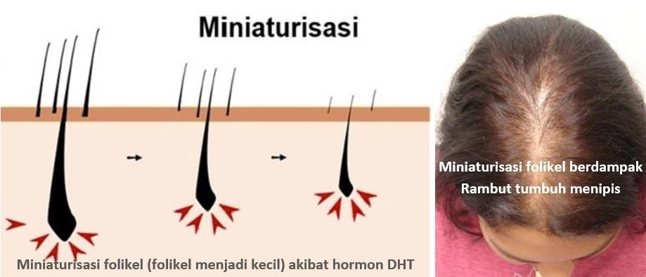 Formula Rambut Kembali Tumbuh Sehat Kuat Dan Lebat Untuk Pria Dan